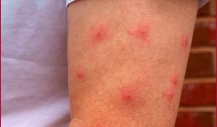 5 habitudes d’été qui augmentent le risque de cancer de la peau chez les femmes