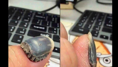 Adieu mycose des ongles : découvrez le secret naturel pour l’éliminer rapidement !