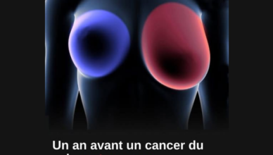 Cancer du sein : 4 signes précoces à ne jamais ignorer pour agir rapidement